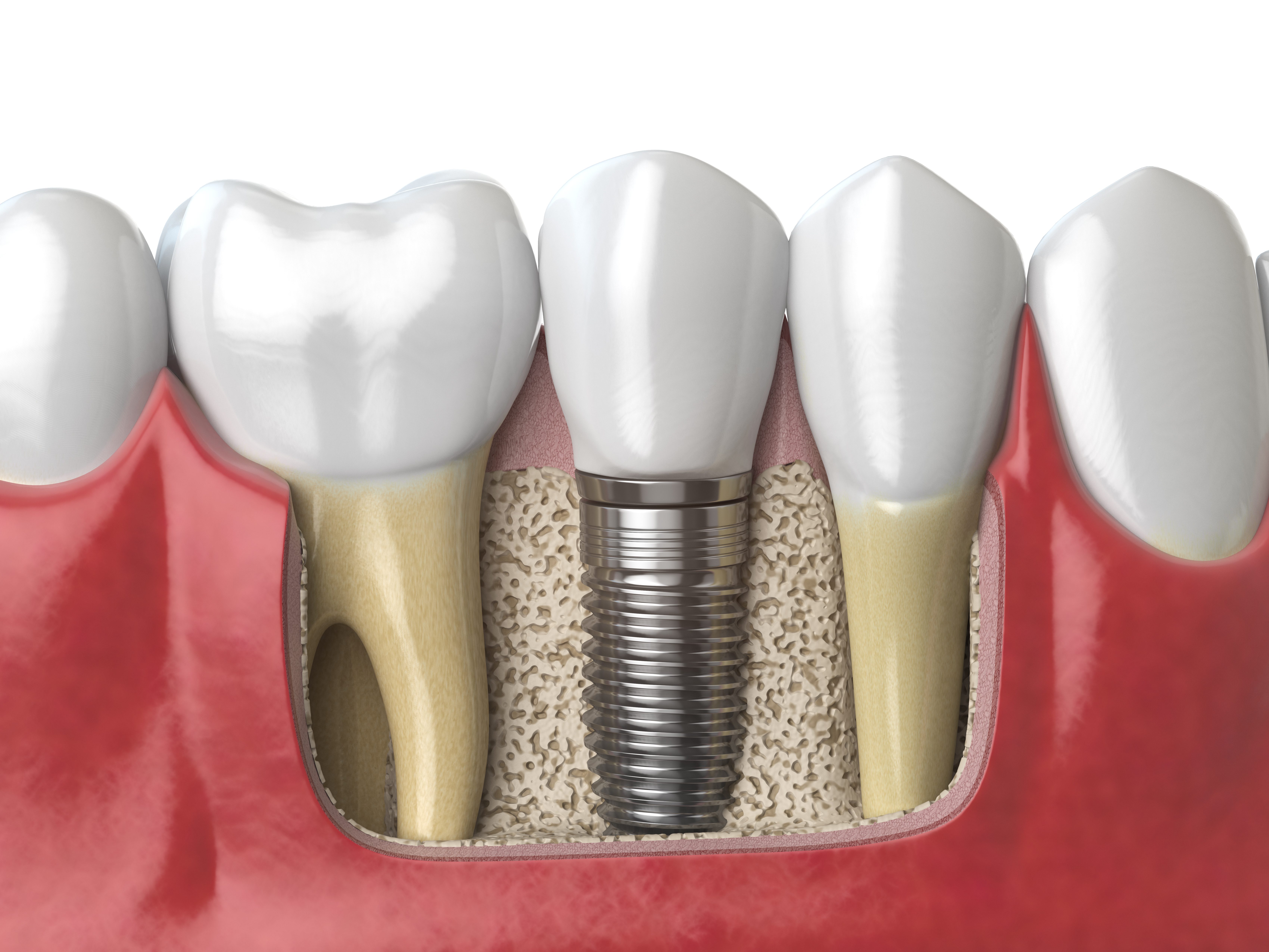 Anatomy of healthy teeth and tooth dental implant
