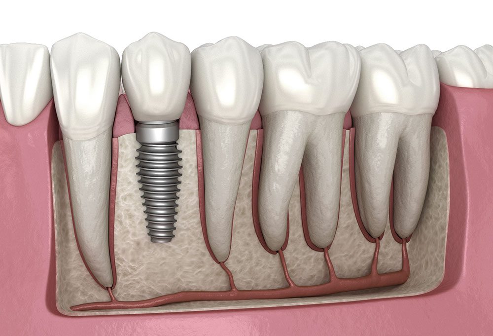 dental implant illustration side view