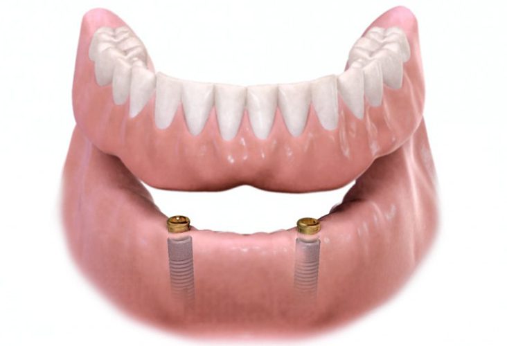 Implant-supported-overdenture-oral-surgeon-washington-dc-bethesda-e1462753290613