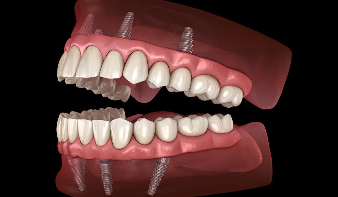 Dental Implants Houston
