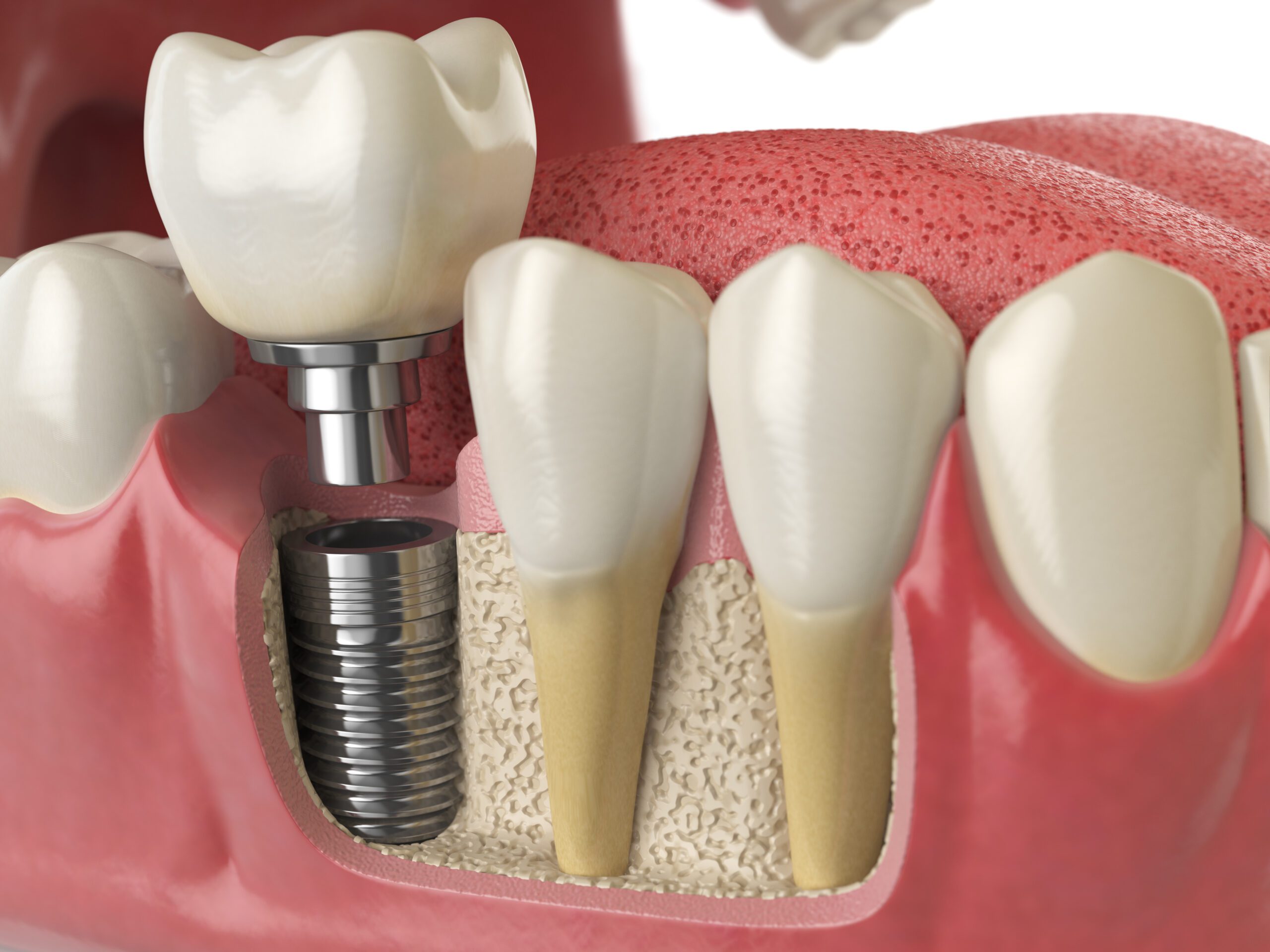 Painful Dental Implants