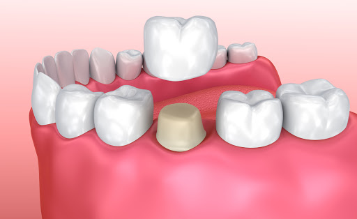 Crown Or Bridge For Teeth Work