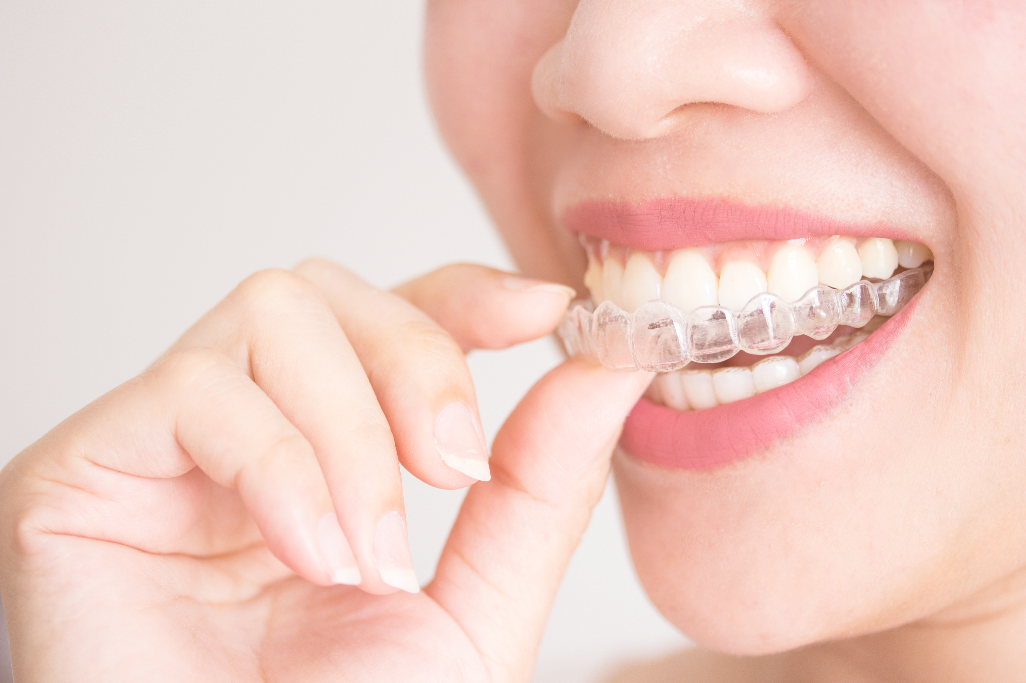 In-Office vs. At-Home Aligners
